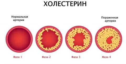 Высокий холестерин — в чем опасность — Полезная информация