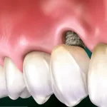 Периимплантит: Тихий враг имплантата