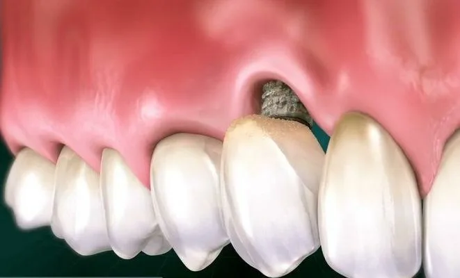 Периимплантит: Тихий враг имплантата